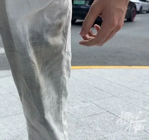 口袋里的罗马仕充电宝突然起火25岁小伙左腿三级烧伤！非召回批次买来不到一年(图2)